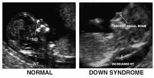 Translucency result nuchal ultrasound 